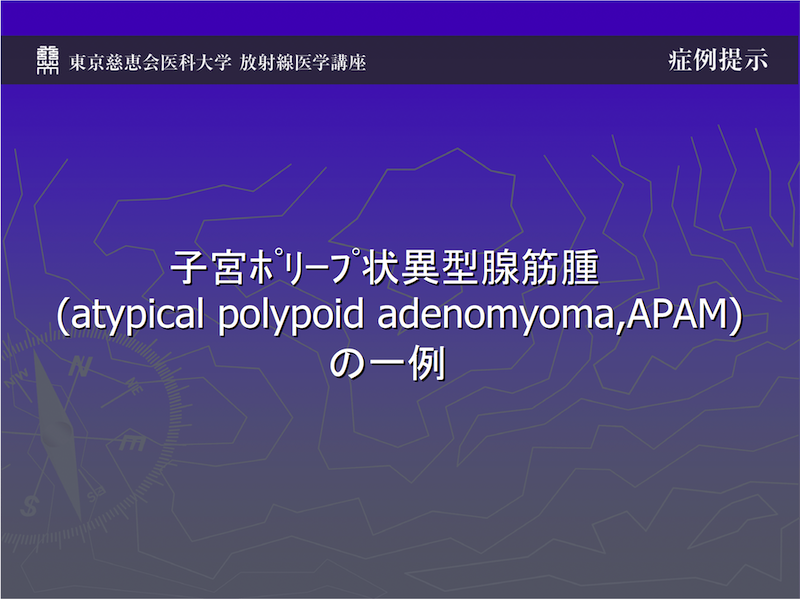子宮ポリープ状異型腺筋腫（atypical polypoid adenomyoma,APAM）の一例