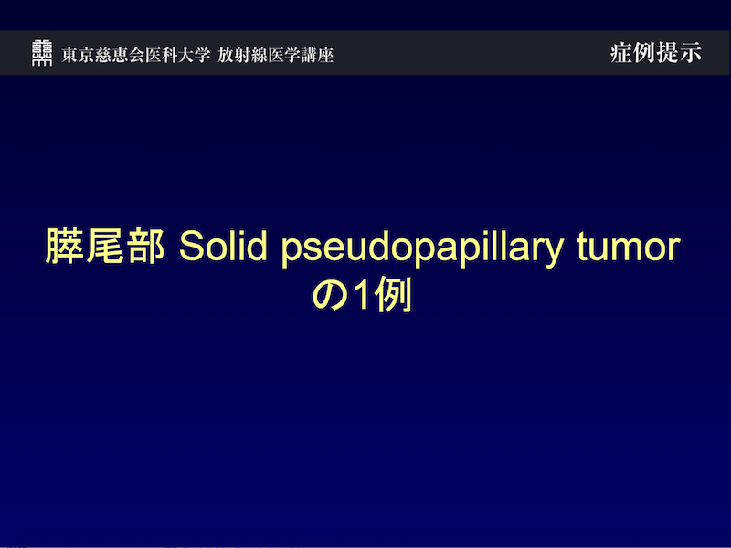 膵尾部 Solid pseudopapillary tumorの1例