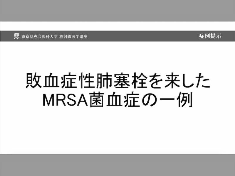 敗血症性肺塞栓を来したMRSA菌血症の一例