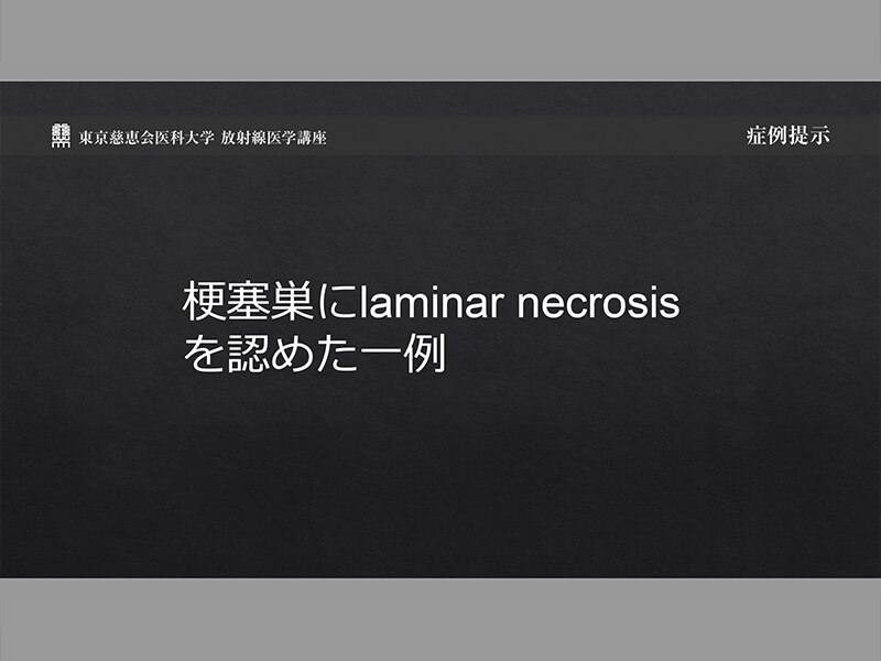 梗塞巣にlaminar necrosisを認めた一例