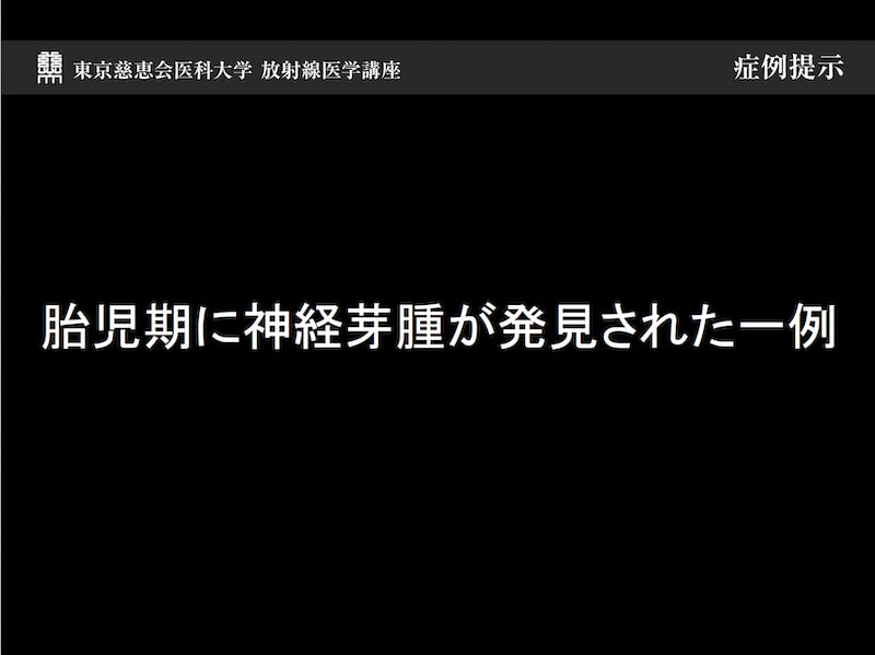 胎児期に神経芽腫が発見された一例