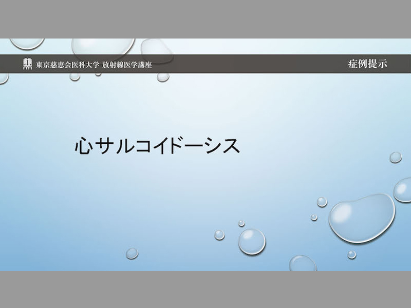 心サルコイドーシス