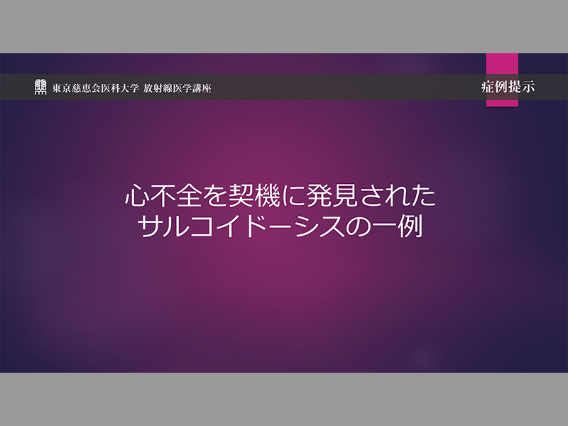 心不全を契機に発見されたサルコイドーシスの一例