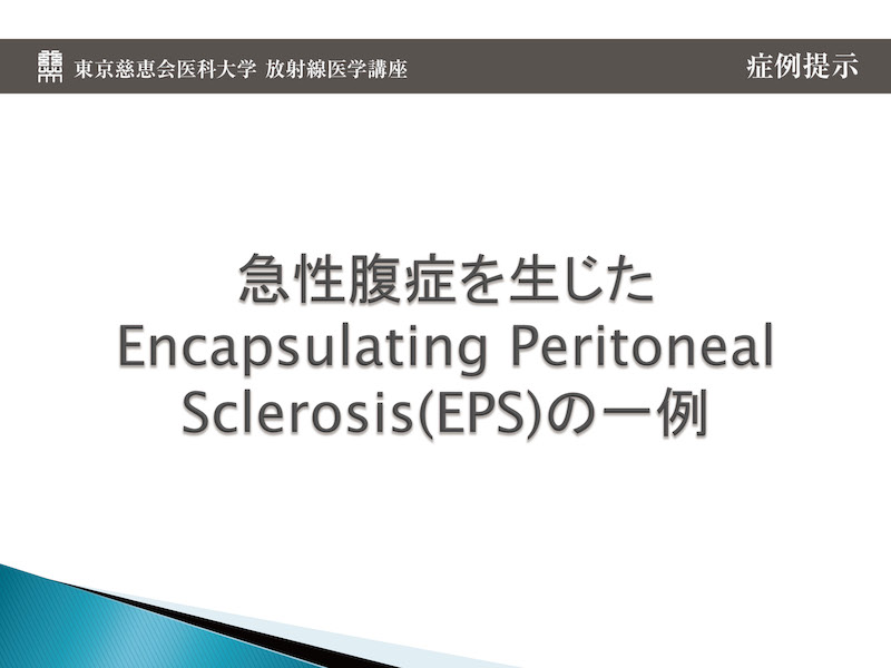 急性腹症を生じたEncapsulating Peritoneal Sclerosis(EPS)の一例