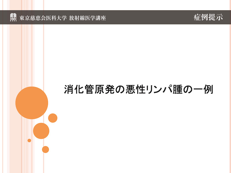消化管原発の悪性リンパ腫の一例