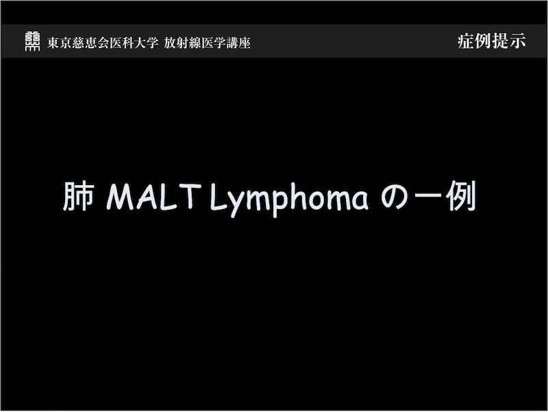 肺 MALT Lymphoma の一例