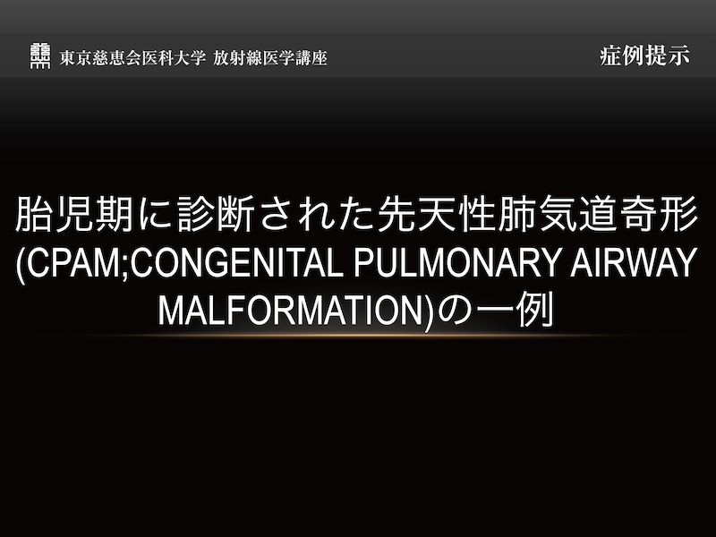胎児期に診断された先天性肺気道奇形 (CPAM;COngenital pulmonary airway malformation)の一例